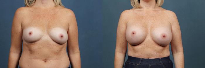 Before & After Enlargement - Silicone Case 379 View #1 View in Louisville & Lexington, KY