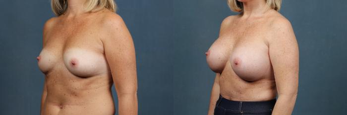 Before & After Enlargement - Silicone Case 379 View #2 View in Louisville & Lexington, KY