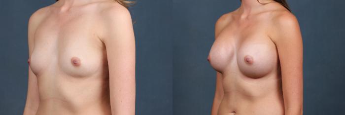 Before & After Enlargement - Silicone Case 380 View #2 View in Louisville & Lexington, KY
