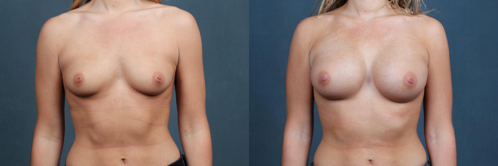 Before & After Enlargement - Silicone Case 382 View #1 View in Louisville & Lexington, KY