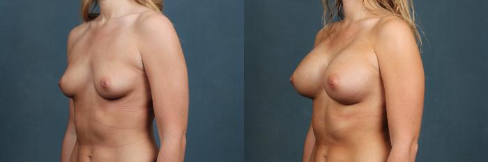 Before & After Enlargement - Silicone Case 382 View #2 View in Louisville & Lexington, KY