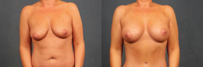 Before & After Enlargement - Silicone Case 383 View #1 View in Louisville & Lexington, KY