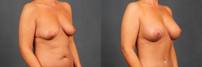 Before & After Enlargement - Silicone Case 383 View #2 View in Louisville & Lexington, KY