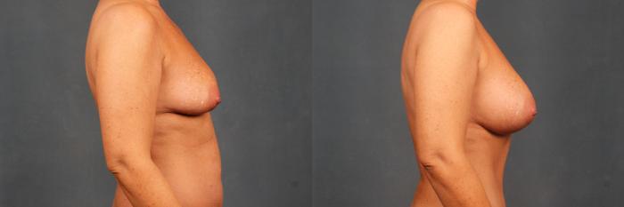 Before & After Enlargement - Silicone Case 383 View #3 View in Louisville & Lexington, KY