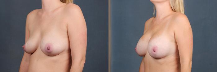 Before & After Enlargement - Silicone Case 384 View #2 View in Louisville & Lexington, KY