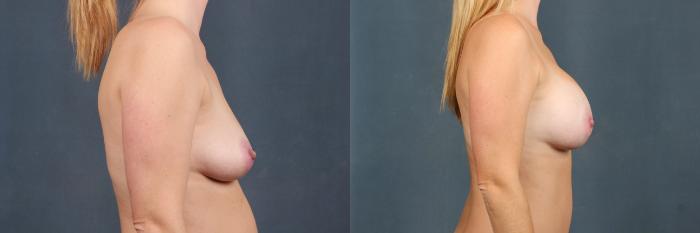 Before & After Enlargement - Silicone Case 384 View #3 View in Louisville & Lexington, KY