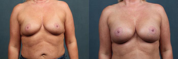 Before & After Enlargement - Silicone Case 385 View #1 View in Louisville & Lexington, KY