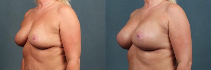 Before & After Enlargement - Silicone Case 385 View #2 View in Louisville & Lexington, KY