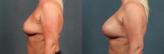 Before & After Enlargement - Silicone Case 385 View #3 View in Louisville & Lexington, KY