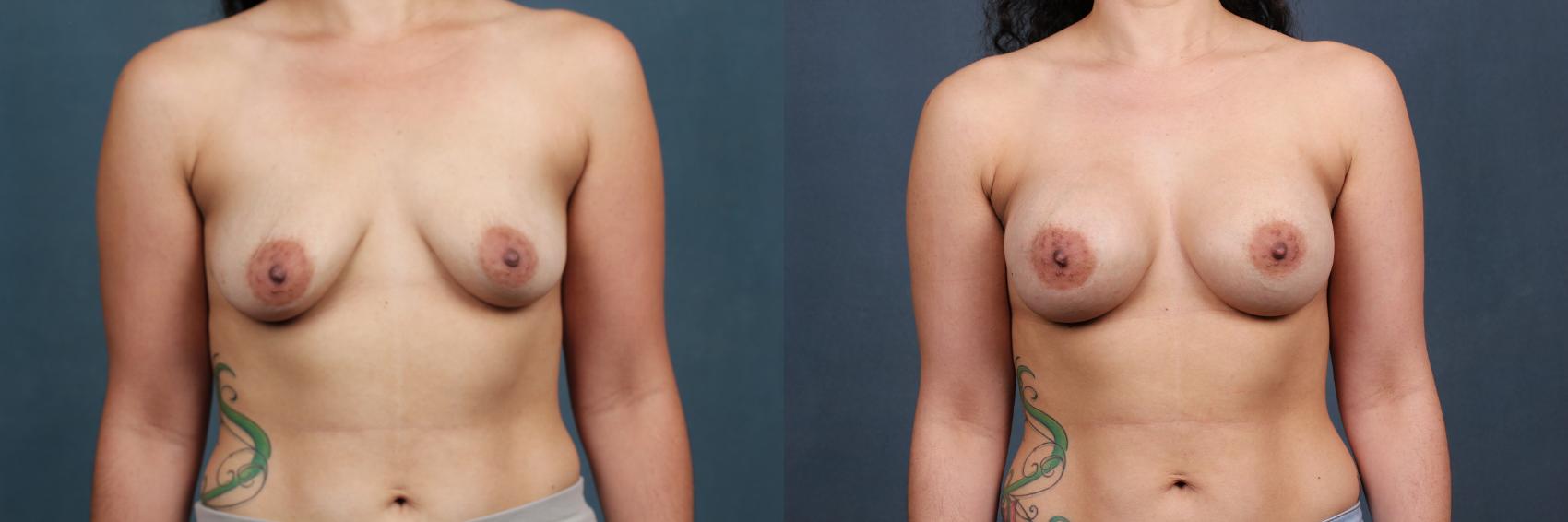 Before & After Enlargement - Silicone Case 387 View #1 View in Louisville & Lexington, KY