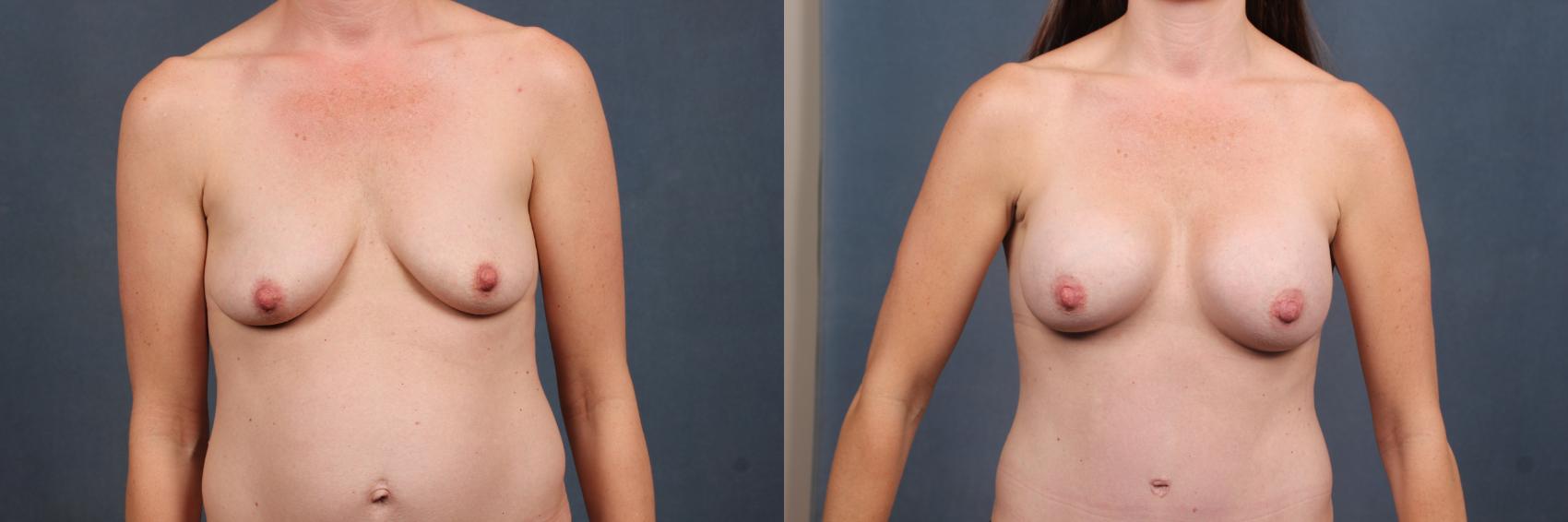 Before & After Enlargement - Silicone Case 388 View #1 View in Louisville & Lexington, KY