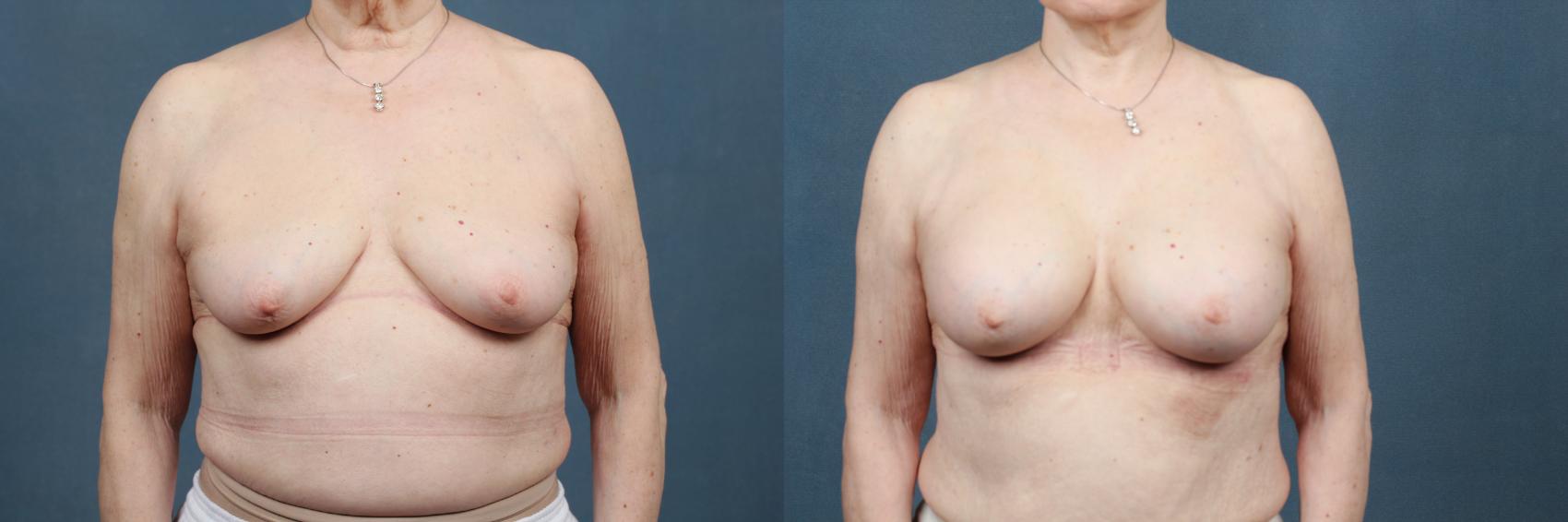 Before & After Enlargement - Silicone Case 390 View #1 View in Louisville & Lexington, KY