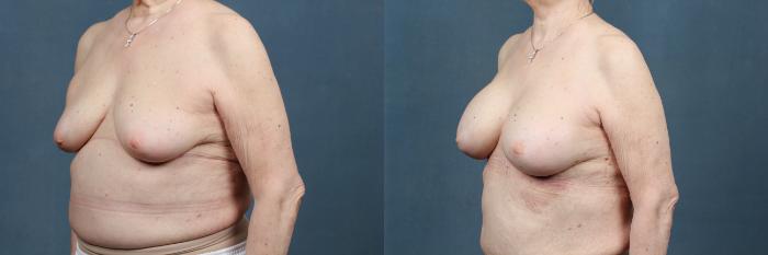 Before & After Enlargement - Silicone Case 390 View #2 View in Louisville & Lexington, KY