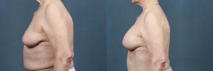 Before & After Enlargement - Silicone Case 390 View #3 View in Louisville & Lexington, KY