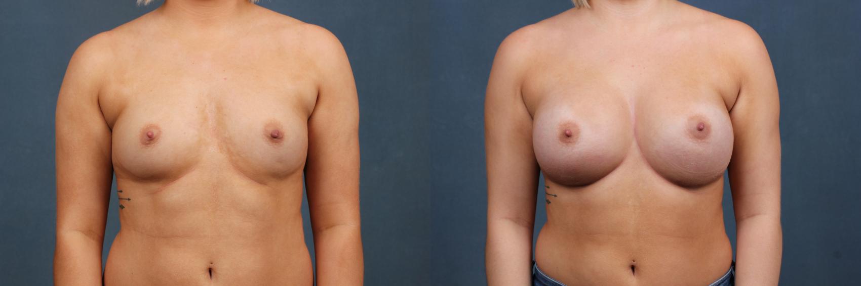 Before & After Enlargement - Silicone Case 391 View #1 View in Louisville & Lexington, KY