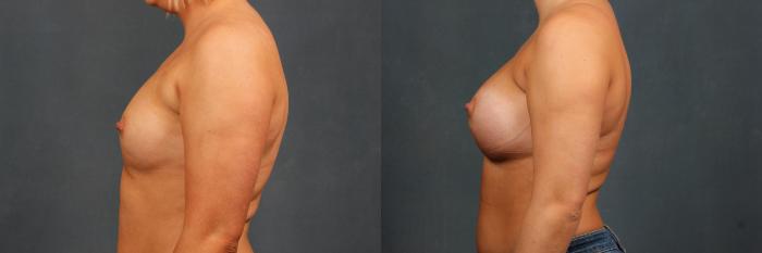 Before & After Enlargement - Silicone Case 391 View #3 View in Louisville & Lexington, KY