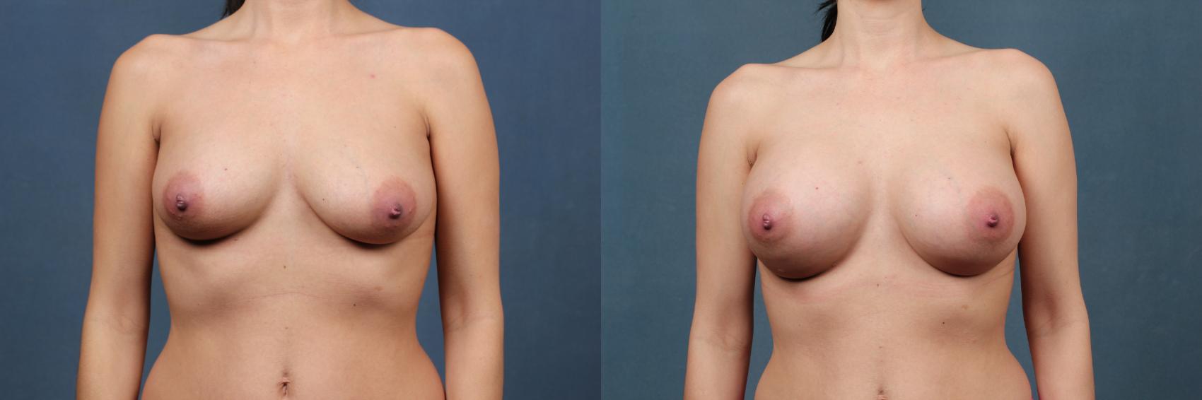 Before & After Enlargement - Silicone Case 392 View #1 View in Louisville & Lexington, KY