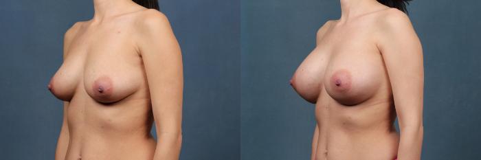Before & After Enlargement - Silicone Case 392 View #2 View in Louisville & Lexington, KY