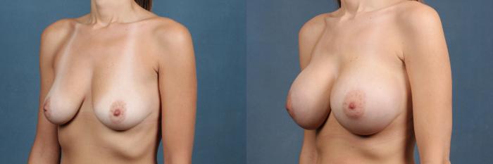 Before & After Enlargement - Silicone Case 394 View #2 View in Louisville & Lexington, KY