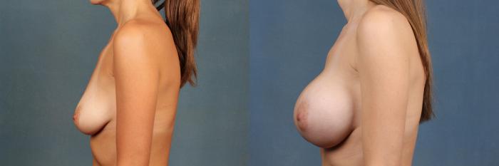 Before & After Enlargement - Silicone Case 394 View #3 View in Louisville & Lexington, KY