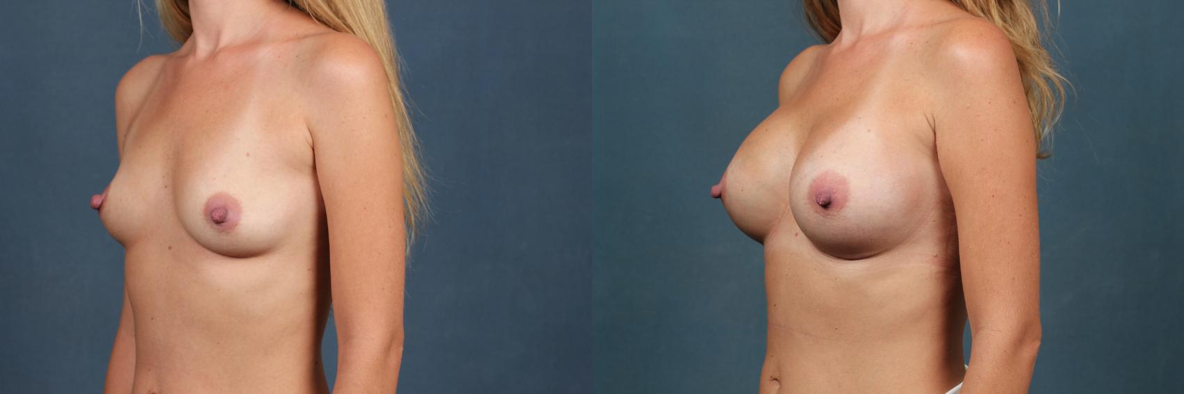 Before & After Enlargement - Silicone Case 395 View #3 View in Louisville & Lexington, KY