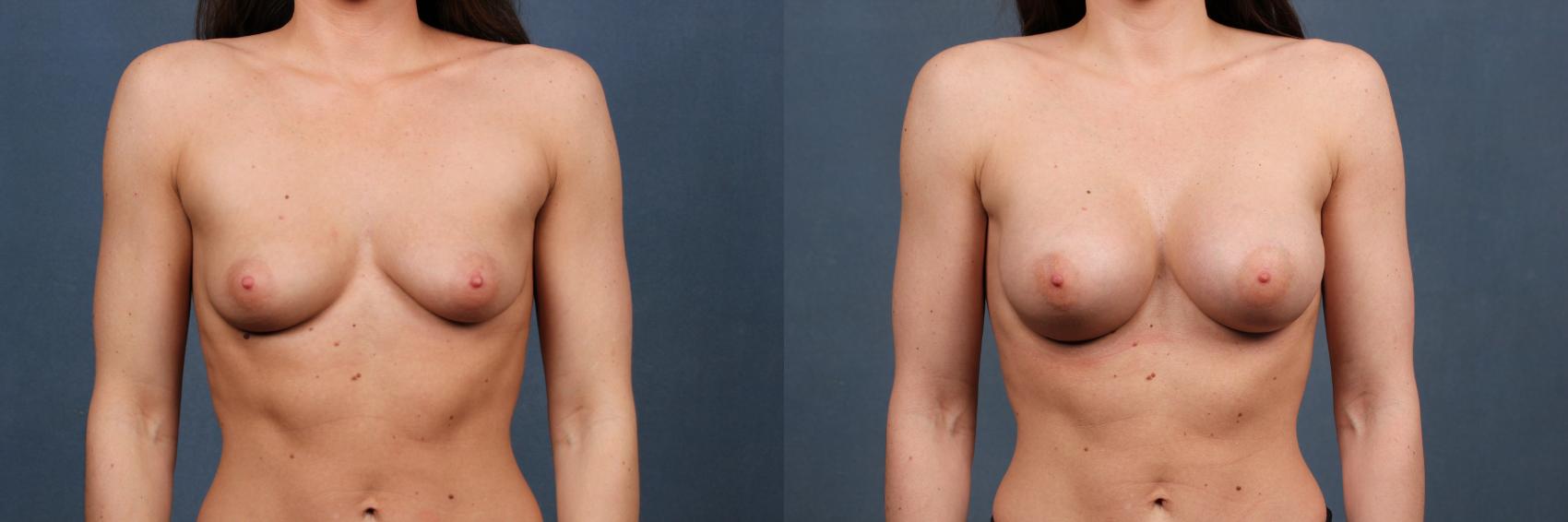 Before & After Enlargement - Silicone Case 396 View #1 View in Louisville & Lexington, KY