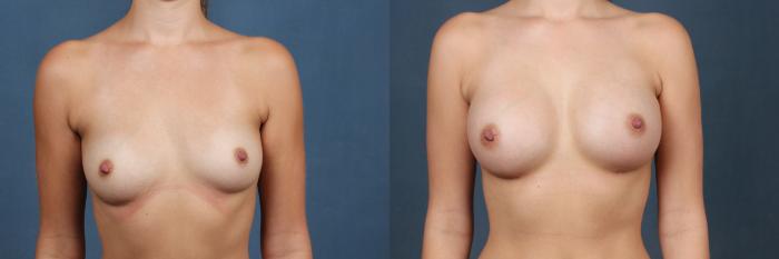 Before & After Enlargement - Silicone Case 474 View #1 View in Louisville & Lexington, KY