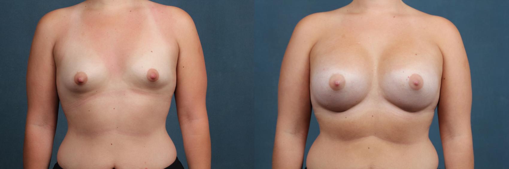 Before & After Enlargement - Silicone Case 475 View #1 View in Louisville & Lexington, KY