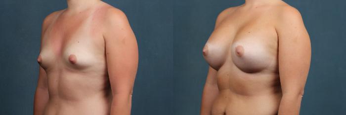 Before & After Enlargement - Silicone Case 475 View #2 View in Louisville & Lexington, KY