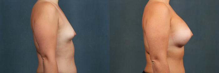 Before & After Enlargement - Silicone Case 475 View #3 View in Louisville & Lexington, KY