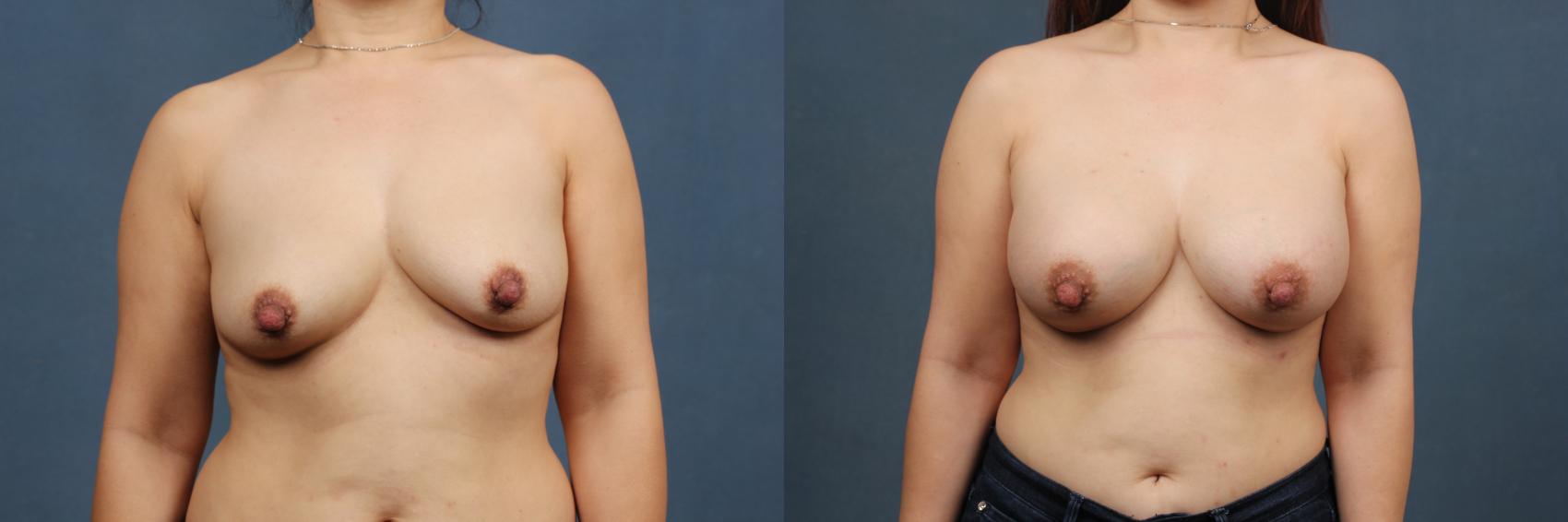 Before & After Enlargement - Silicone Case 476 View #1 View in Louisville & Lexington, KY