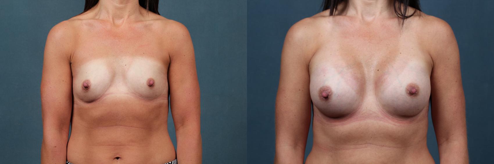 Before & After Enlargement - Silicone Case 477 View #1 View in Louisville & Lexington, KY