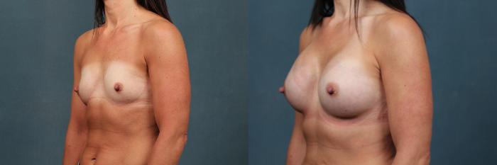 Before & After Enlargement - Silicone Case 477 View #2 View in Louisville & Lexington, KY