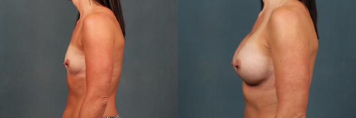 Before & After Enlargement - Silicone Case 477 View #3 View in Louisville & Lexington, KY