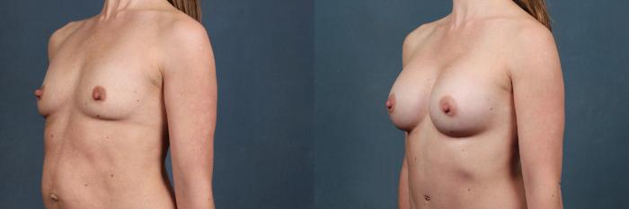Before & After Enlargement - Silicone Case 478 View #2 View in Louisville & Lexington, KY