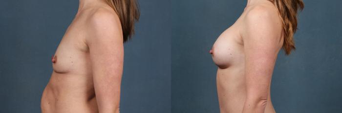 Before & After Enlargement - Silicone Case 478 View #3 View in Louisville & Lexington, KY