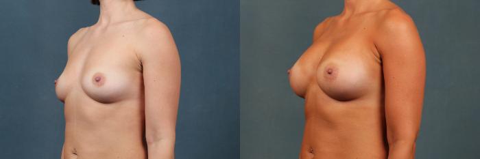 Before & After Enlargement - Silicone Case 479 View #2 View in Louisville & Lexington, KY