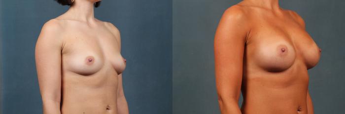 Before & After Enlargement - Silicone Case 479 View #3 View in Louisville & Lexington, KY