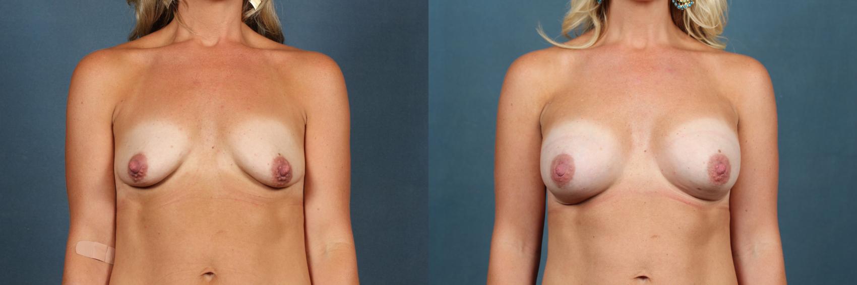 Before & After Enlargement - Silicone Case 480 View #1 View in Louisville & Lexington, KY