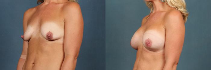 Before & After Enlargement - Silicone Case 480 View #2 View in Louisville & Lexington, KY