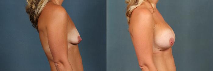 Before & After Enlargement - Silicone Case 480 View #3 View in Louisville & Lexington, KY