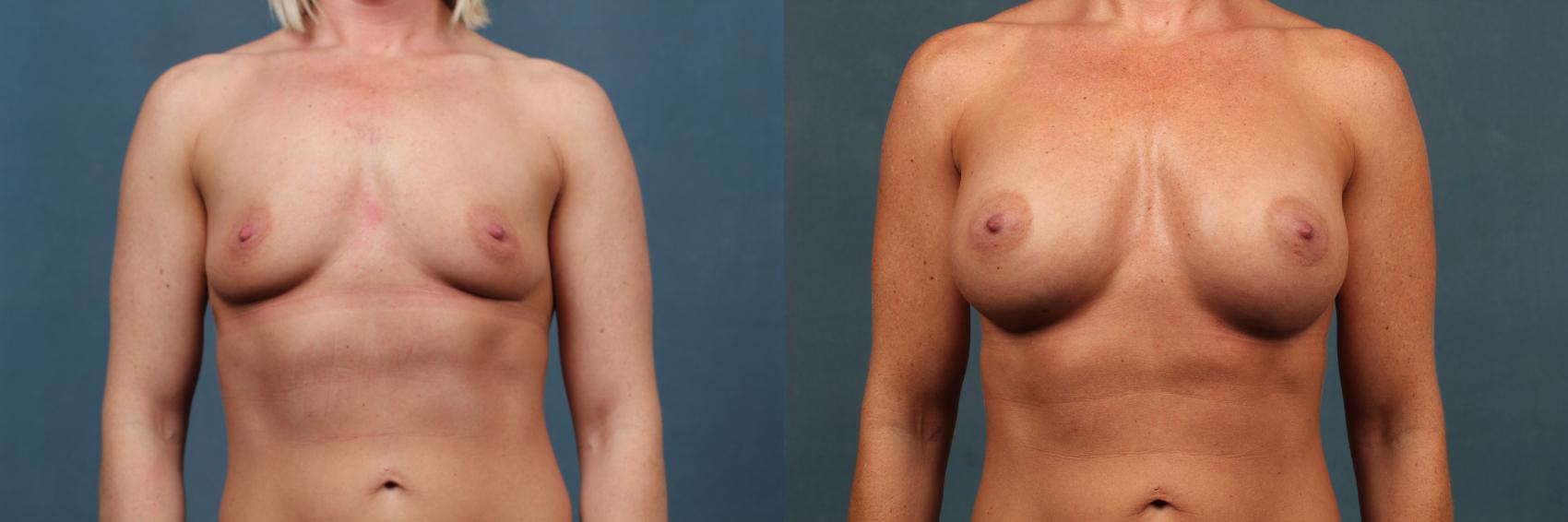 Before & After Enlargement - Silicone Case 481 View #1 View in Louisville & Lexington, KY