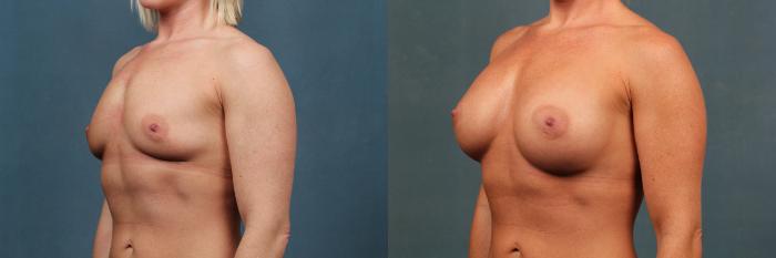 Before & After Enlargement - Silicone Case 481 View #2 View in Louisville & Lexington, KY