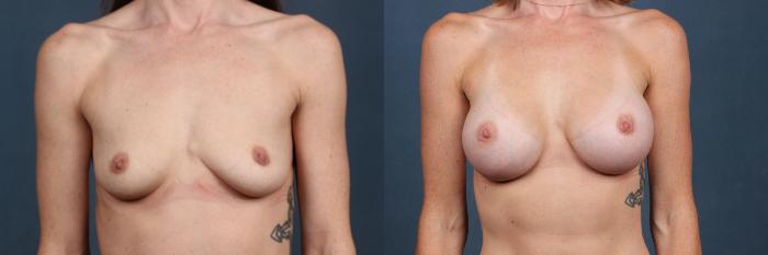 Before & After Enlargement - Silicone Case 483 View #1 View in Louisville & Lexington, KY