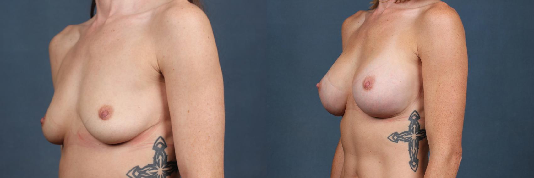 Before & After Enlargement - Silicone Case 483 View #2 View in Louisville & Lexington, KY