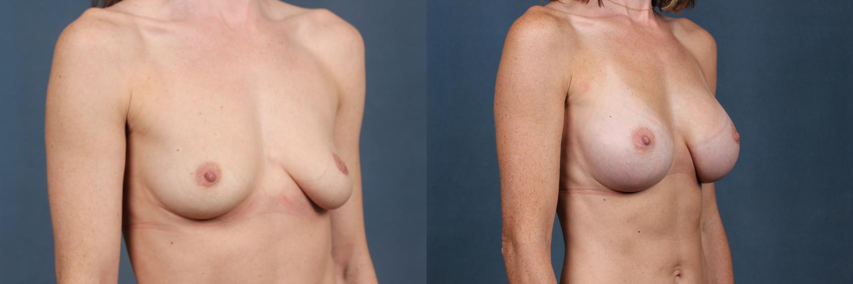 Before & After Enlargement - Silicone Case 483 View #4 View in Louisville & Lexington, KY