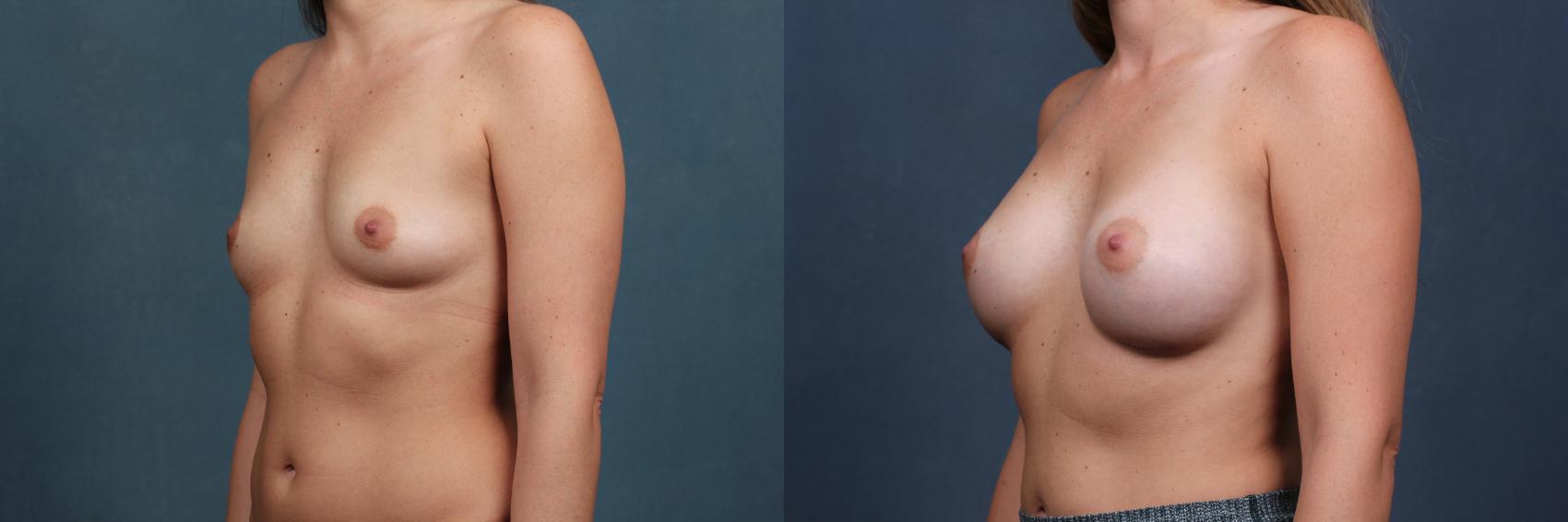 Before & After Enlargement - Silicone Case 485 View #2 View in Louisville & Lexington, KY