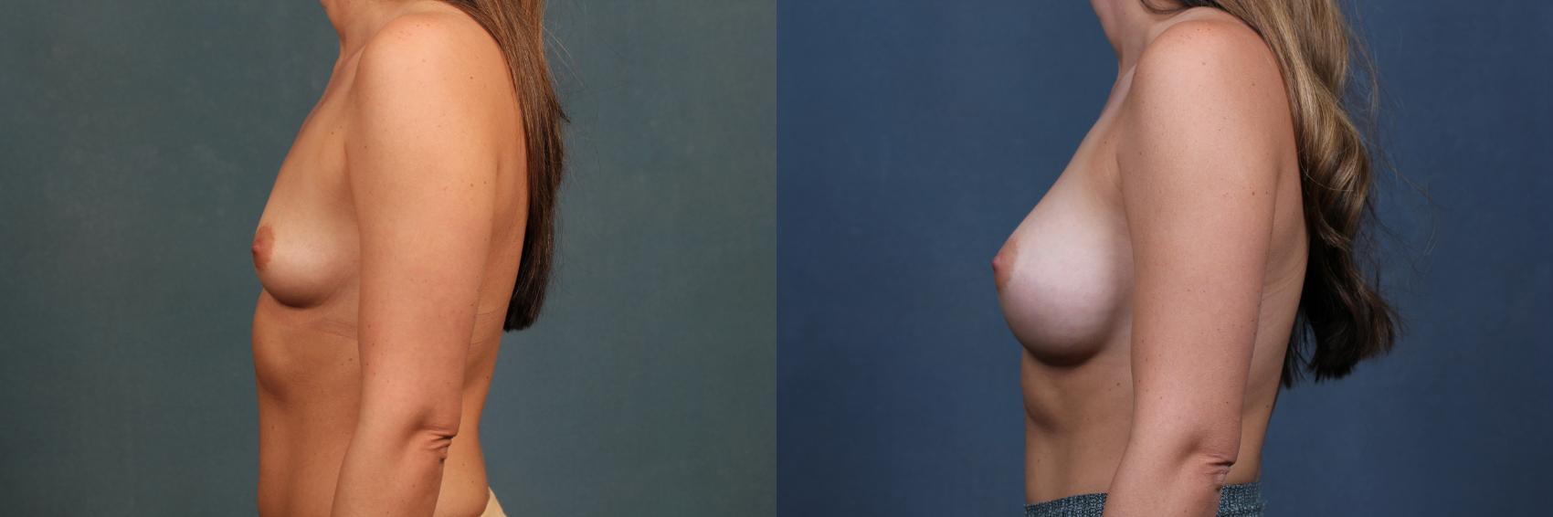 Before & After Enlargement - Silicone Case 485 View #3 View in Louisville & Lexington, KY