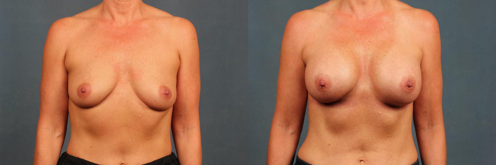 Before & After Enlargement - Silicone Case 488 View #1 View in Louisville & Lexington, KY