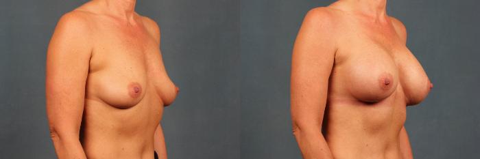 Before & After Enlargement - Silicone Case 488 View #2 View in Louisville & Lexington, KY